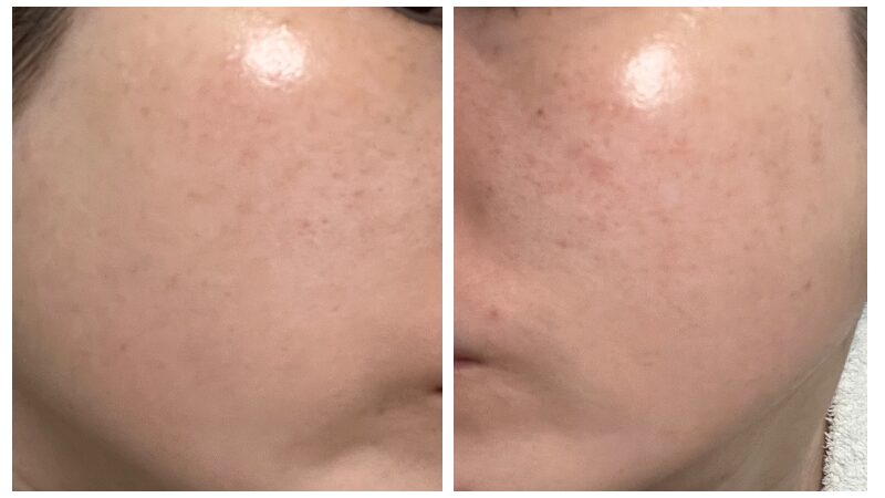 ピココンビ施術5回目から1か月後のニキビ跡が目立ちにくくなった頬の肌状態
