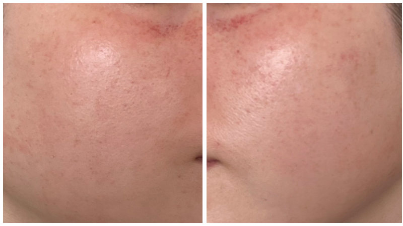 ピココンビ施術5回目翌日の赤みが残る頬の肌状態
