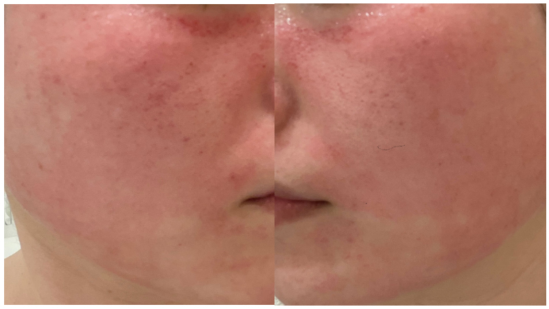 ピココンビ施術5回目直後の赤みが出ている頬の肌状態
