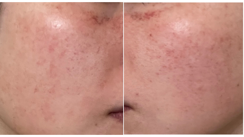 ピココンビ施術5回目から2日後の赤みが落ち着いてきた頬の肌状態
