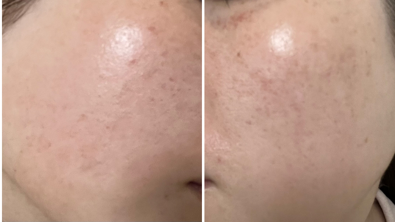 ピココンビ施術5回目から３～４日後の赤みが落ち着いてきた頬の肌状態
