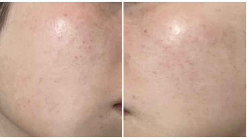 ピココンビ施術5回目から1週間後の肌のなめらかさが出てきた頬の状態
