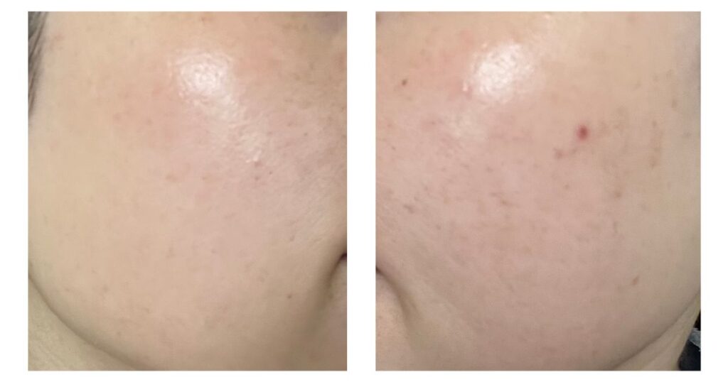 ピココンビ5回施術終了から2か月後の肌状態|トーンアップ効果が続いている頬の様子